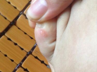 脚上起小水泡很痒是怎么回事,原因、预防和治疗方法”